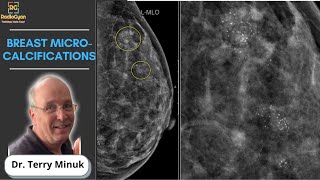 Mastering Mammography Understanding Breast Microcalcifications  Dr Terry Minuk [upl. by Anilram741]