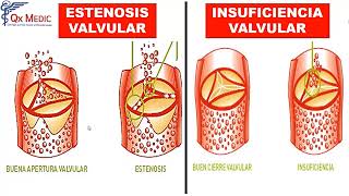 Valvulopatías de hemicardio izquierdo [upl. by Utta564]