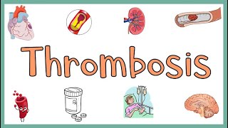 Thrombosis  Definition Causes Types Morphology Fate of a Thrombus amp Clinical manifestations [upl. by Ruyam]