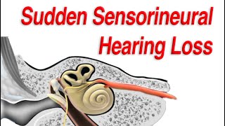 Sudden Sensorineural Hearing Loss Diagnosis Causes and Treatment [upl. by Knuth3]