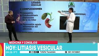 Litiasis vesicular cómo prevenir a tiempo [upl. by Min963]