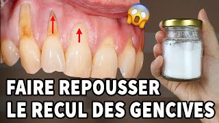 Incroyable Il S’agit D’un Remède À La Maison Pour La Récession Gingivale [upl. by Anuqahs569]