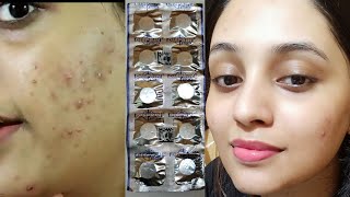 most effective acne face mask  Treatment of acne with DISPRIN  How to use DISPRIN as skincare [upl. by Sherlock]