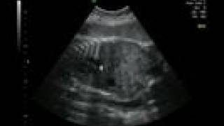 Life in the Womb IV 33 weeks ultrasound [upl. by Mathi827]