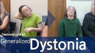 Dystonia  Generalized Dystonia  사경증  전신사경증 [upl. by Jerrilyn]