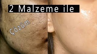 GÖZENEKLERİ SIKILAŞTIRAN Yağlı Cilt İçin \u00100 Doğal Peeling Maske  Güzellik Bakım [upl. by Kirkpatrick]