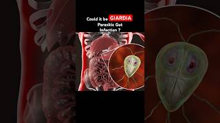 Giardia Infection is often mistaken for IBS Symptoms guthealth shorts youtubeshorts [upl. by Akimrej]