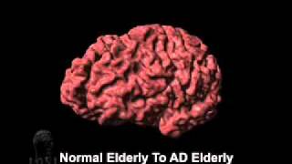 Cortical Atrophy Associated with Alzheimers Disease [upl. by Dodge258]