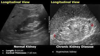 Kidney Ultrasound Normal Vs Chronic Kidney Disease CKD Imaging Findings  Chronic Renal Failure [upl. by Sebastian523]