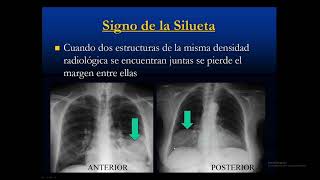 Patología Pulmonar  Enfermedades que aumentan la densidad [upl. by Esirehs]