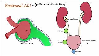 Acute Kidney Injury AKI  PrerenalIntrarenalPostrenal [upl. by Pierro]