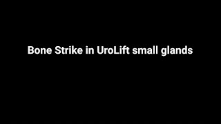 Bone Strike in UroLift small glands [upl. by Nyliac]