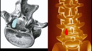 Behandlung der Spinalkanalstenose [upl. by Marr]