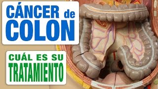 Cáncer de Colon  Tratamiento [upl. by Aztinaj]