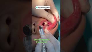 DENTAL IMPLANT INSERTION INTO BONE BY DENTAL IMPLANT SPECIALIST DR MUHAMMAD AHMAD [upl. by Anilos]