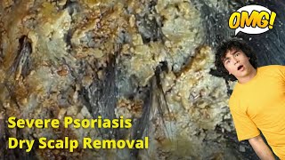 Removal of SEVERE Psoriasis Seborrheic Dermatitis Dry Scalp amsr [upl. by Graehme]