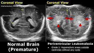 Neonatal Brain Ultrasound Normal Vs Abnormal Images  Full Term Infant amp Premature Newborn Head USG [upl. by Laughry]