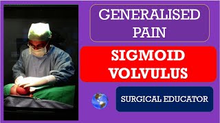 SIGMOID VOLVULUS How To DIAGNOSE amp TREAT Generalised Abdominal Pain [upl. by Jessalyn]