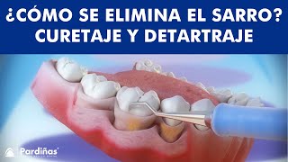 ¿Cómo se ELIMINA EL SARRO  Curetaje y limpieza dental © [upl. by Casabonne574]