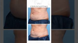 CoolSculpting before and after body contouring results to remove stubborn fat bodysculpting [upl. by Nahem]