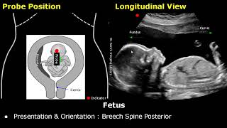 Obstetric Ultrasound Probe Positioning  Pregnant Uterus amp Fetus Transducer Placement USG Scan [upl. by Ramberg]