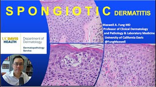 DERMATOPATHOLOGY Spongiotic Dermatitis [upl. by Debee]