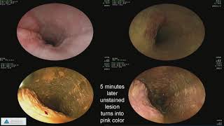 Early Detection of Esophageal Cancer and Barrett’s Esophagus Recent Advances [upl. by Stockmon554]