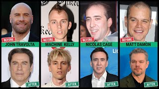 Celebrities Before and After Hair Transplantation [upl. by Adiaros996]