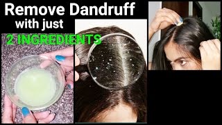 Magical Home Remedy to Remove DANDRUFF at homeDandruff treatmentHow to get rid of dandruff [upl. by Agn791]