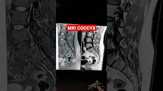 MRI of Coccyx  Post Traumatic Fracture mri shorts mriradiographer MRI L S Spine with Coccyx [upl. by Beach]