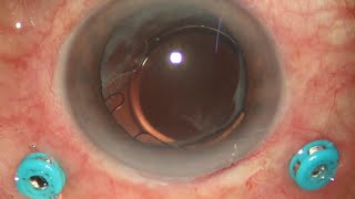 Scleral fixation of subluxated single piece IOL [upl. by Ahsram]