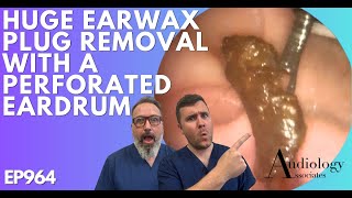 HUGE EAR WAX PLUG REMOVAL WITH A PERFORATED EARDRUM  EP964 [upl. by Nessie]