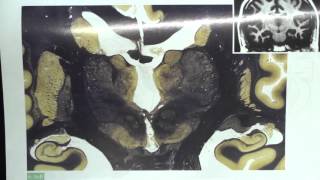 Thalamic Nuclei Brain Sections [upl. by Anor]