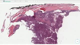 Follicular Carcinoma  Thyroid Gland  Histopathology [upl. by Suk]