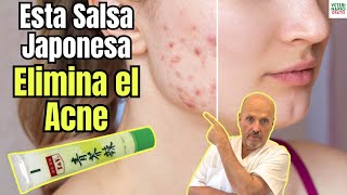 😱COMO ELIMINAR EL ACNE EN LA PIEL CON WASABI😱 [upl. by Notyal107]