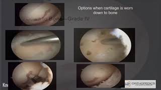 Treatment Options When Cartilage Is Worn Down to Bone [upl. by Godfrey]