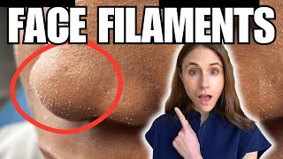 Sebaceous Filaments Vs Demodex Face Mites [upl. by Airotkiv]