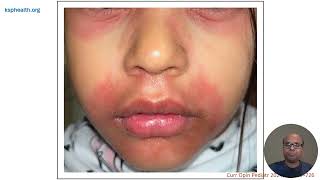 Pediatric Dermatologic Emergencies  Part 1 [upl. by Alamac]