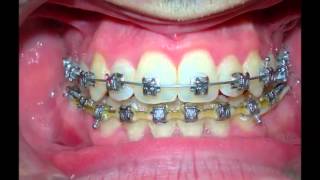 Classe III Damon Orthodontics [upl. by Milli]