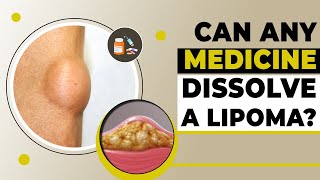 Dissolving a Lipoma With Medicine Is It Possible Lipoma Treatment in Delhi  Dr PK Talwar [upl. by Small856]