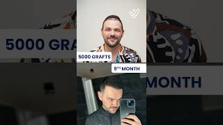 Hair Transformation in 9 Months hairtransplant trendingshorts fuehairtransplant beforeandafter [upl. by Nesto]