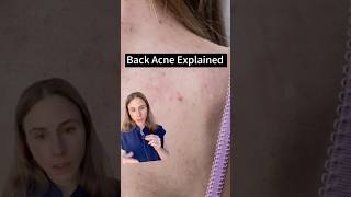 Uncovering The Truth About Back Acne [upl. by Pulsifer]