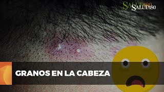 ✅ Cómo lidiar con los GRANOS en la CABEZA  Salud180 🌿 [upl. by Bevvy178]