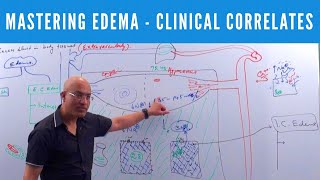 Mastering Edema  Types Causes Symptoms amp Treatment 👨‍⚕️ [upl. by Ayidan451]