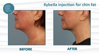 Kybella injection for double chin fat San Diego [upl. by Tsew252]