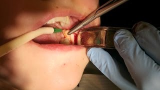 Deeply impacted upper wisdom molar surgical removal video [upl. by Lysander]