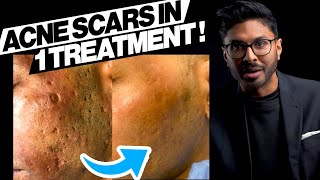 How To Get Rid Of Acne Scars In One Go [upl. by Nileuqcaj]