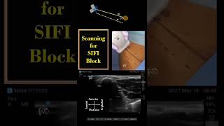 SIFI  PENG Blocks  Scanning Principles  Ultrasoundguided shorts regionalanesthesia DrTuhinM [upl. by Eduardo557]