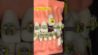 Yellow Colour Braces  Tooth Vlog Orthotics [upl. by Anaujal771]