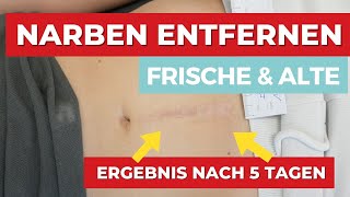 Narben entfernen  frische amp Alte Narben  Das Ergebnis nach 5 Tagen [upl. by Erdied]